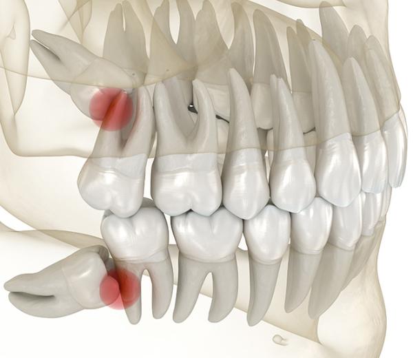 Wisdom teeth